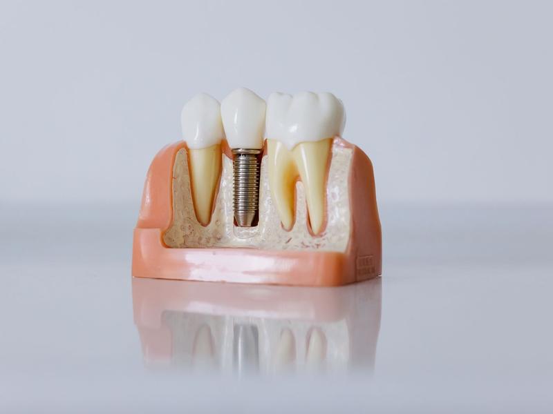 Dental implant model showing the implant post, crown and gum
